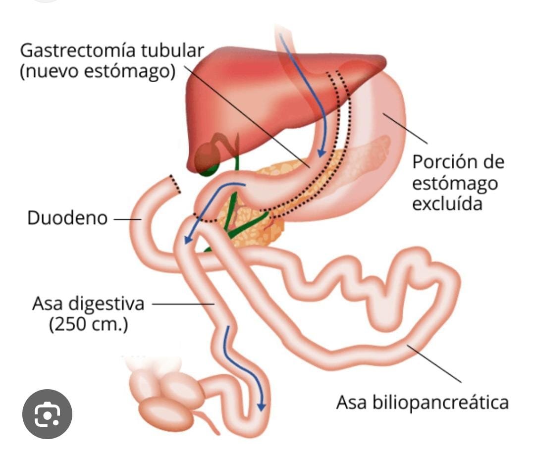 Bypass Gástrico SADIS
